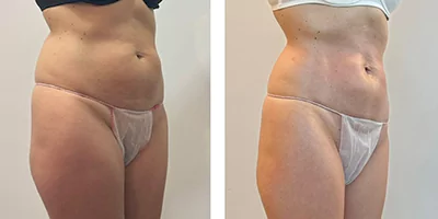 body slimming before after (1)