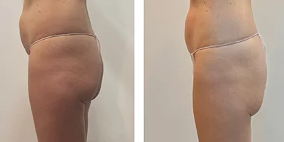 body slimming before after (2)