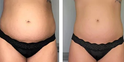 body slimming before after (3)