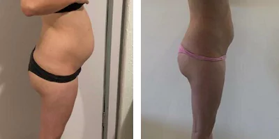 body slimming before after (4)