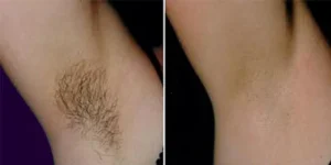 laser hair removal by beauty device before after (1)