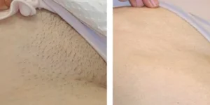 laser hair removal by beauty device before after (10)