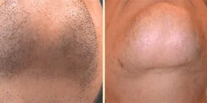 laser hair removal by beauty device before after (2)