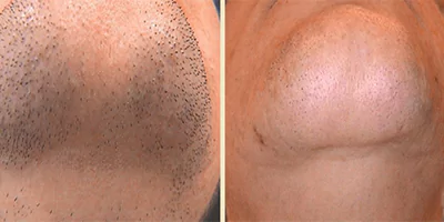 laser hair removal by beauty device before after (2)