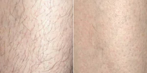 laser hair removal by beauty device before after (3)