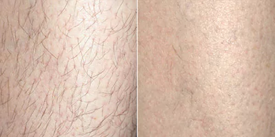 laser hair removal by beauty device before after (3)