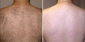 laser hair removal by beauty device before after (4)