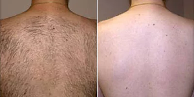 laser hair removal by beauty device before after (4)