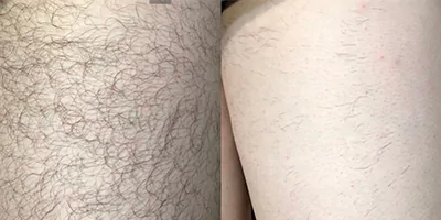 laser hair removal by beauty device before after (5)