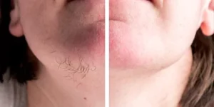 laser hair removal by beauty device before after (6)