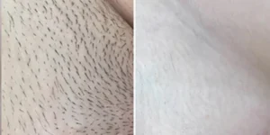 laser hair removal by beauty device before after (7)