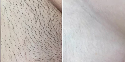 laser hair removal by beauty device before after (7)