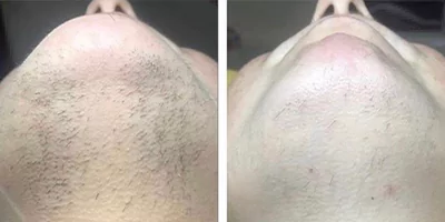 laser hair removal by beauty device before after (8)