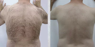 laser hair removal by beauty device before after (9)