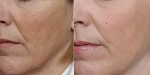 best hydrafacial machine