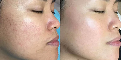 skin rejuvenation before after by beauty machine (2)