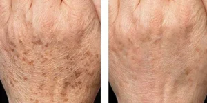 skin rejuvenation before after by beauty machine (3)