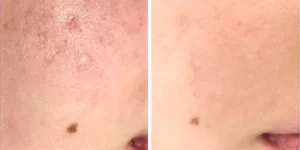 skin rejuvenation before after by beauty machine (4)