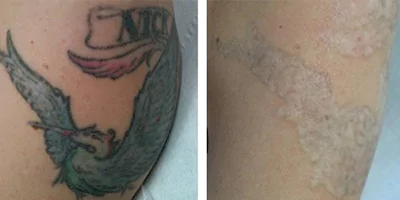 tattoo removal effect by Picosecond Tattoo Laser Removal Machine (1)