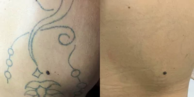 tattoo removal effect by Picosecond Tattoo Laser Removal Machine (2)