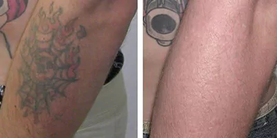 tattoo removal effect by Picosecond Tattoo Laser Removal Machine (3)