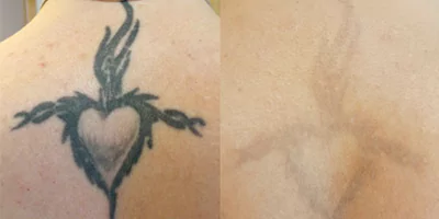 tattoo removal effect by Picosecond Tattoo Laser Removal Machine (4)